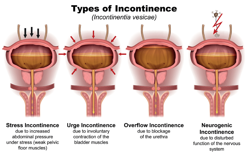 Urinary And Fecal Incontinence Treatment RWJUH New Brunswick